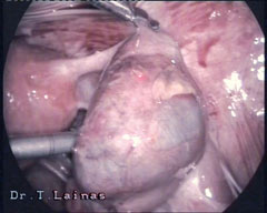 Ectopic pregnancy on right fallopian tube (laparoscopic image).